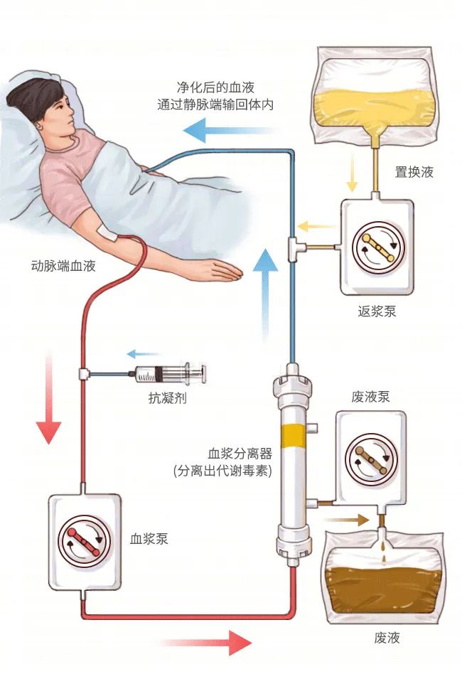 血液净化示意图✦✦血液净化主要包括血液透析,血液过滤,血液置换